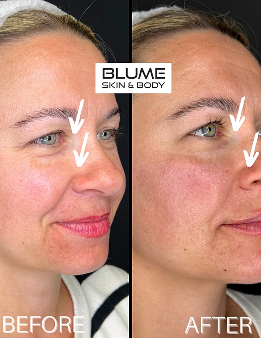 Before and after skin treatment comparison.